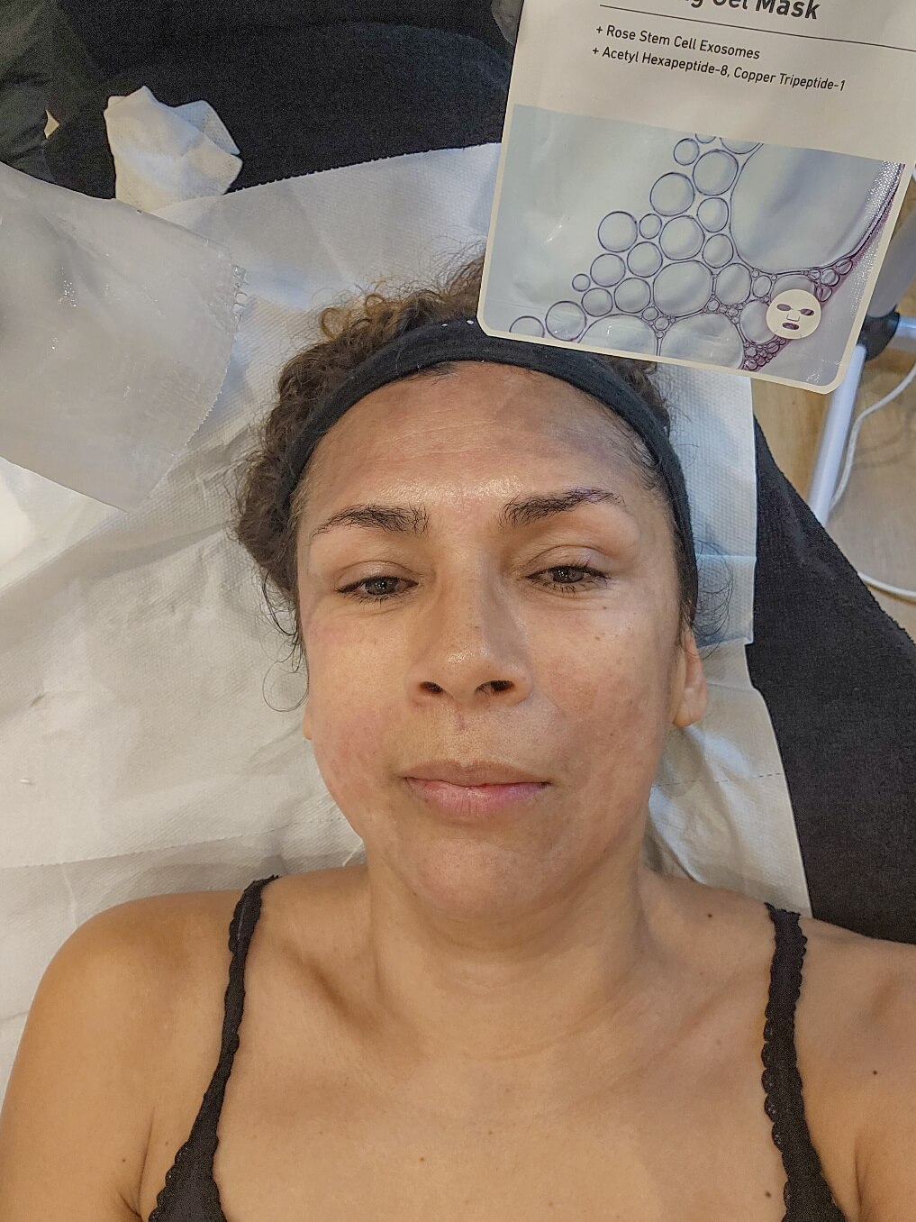 Mi Experiencia Morpheus8 Microagujas Combinadas con Radiofrecuencia en Estética de París